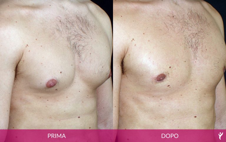 ADDOME-prima-dopo-01
