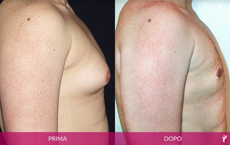 ADDOME-prima-dopo-02