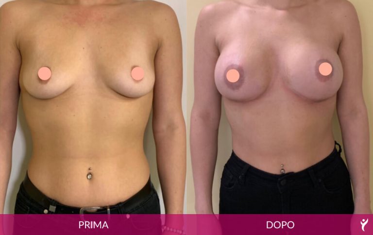 SENO-prima-dopo-02