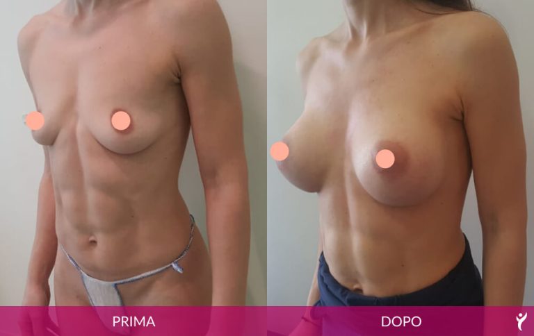 SENO-prima-dopo-03