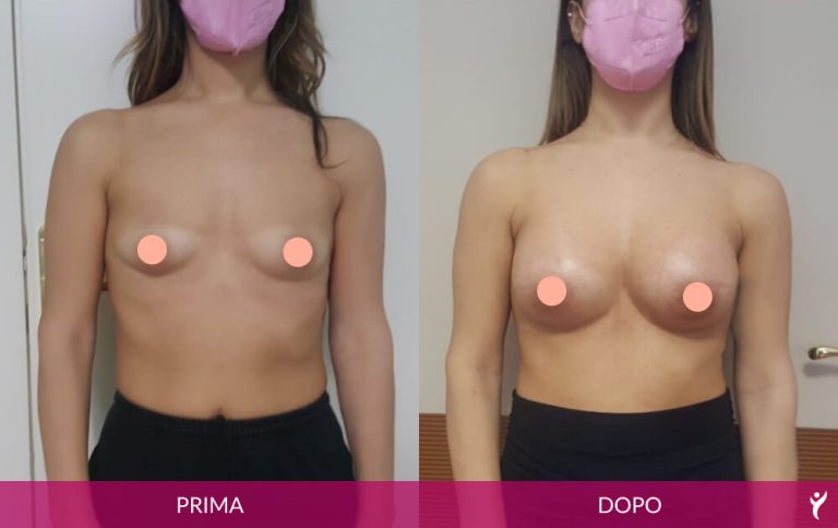 SENO-prima-dopo-04