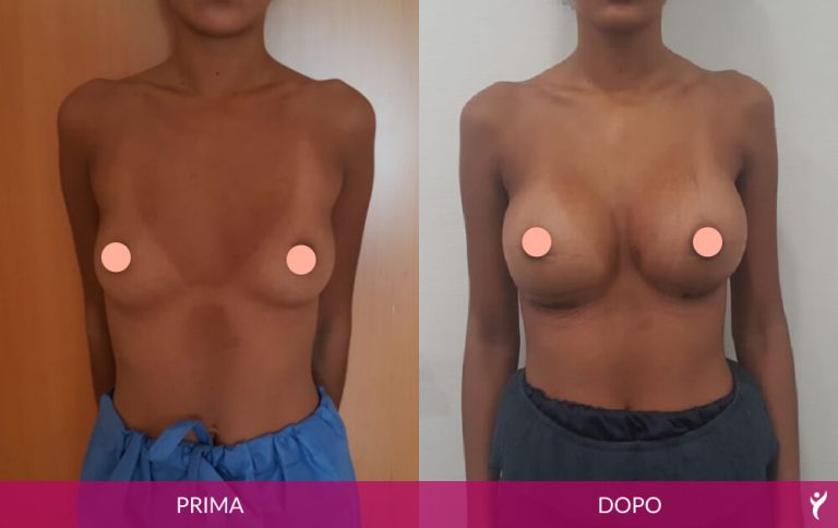 SENO-prima-dopo-05