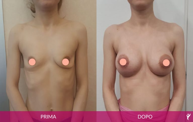 SENO-prima-dopo-06