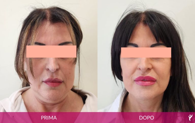 VISO-prima-dopo-01