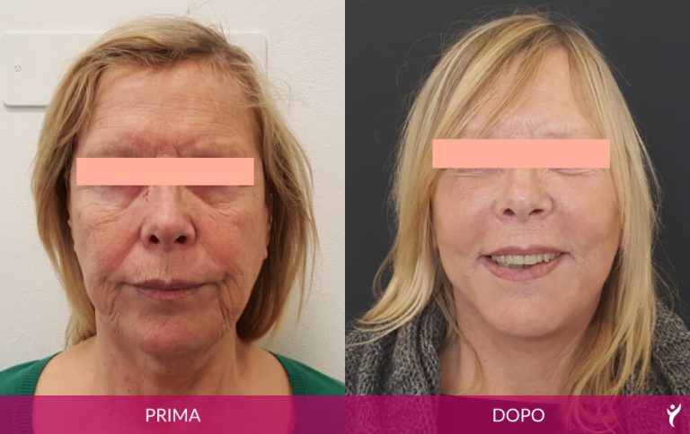 VISO-prima-dopo-02
