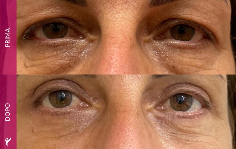 OCCHI-prima-dopo-01