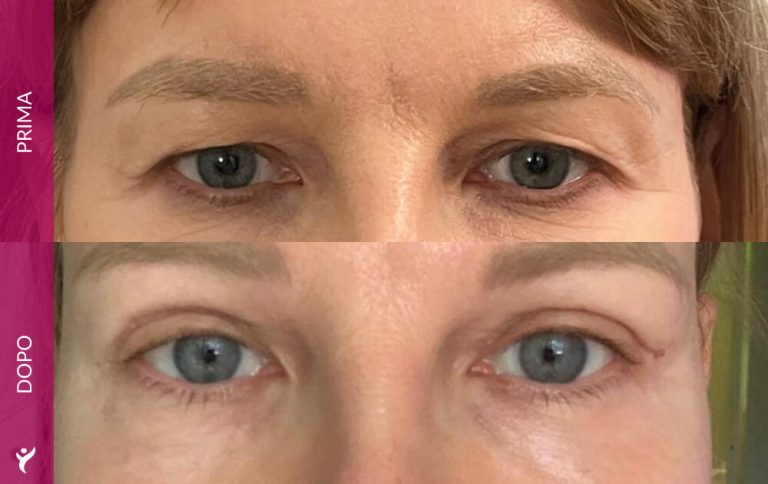 OCCHI-prima-dopo-02