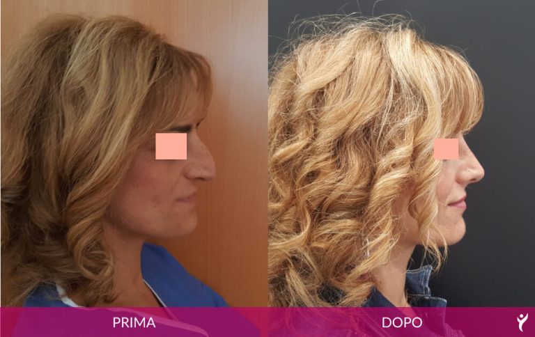 VISO-prima-dopo-04